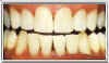 Aging Stains After Applying Teeth Whitening Gel by Brighter Image