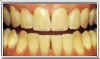 Aging Stains Before Applying Teeth Whitening Gel by Brighter Image